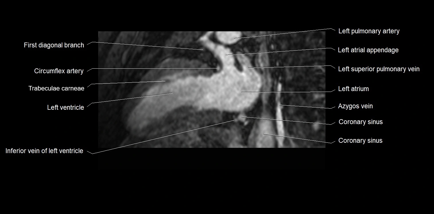 MRI heart and coronary arteries two chamber(sagittal)  anatomy image 28.webp